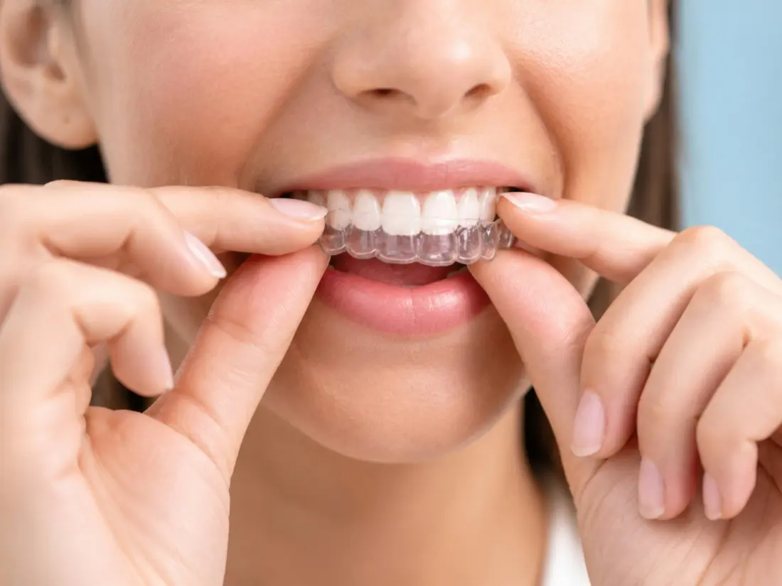 Woman fitting a clear aligner over her teeth